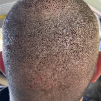 TJ Hair System - Top of the head is where hair was transplanted and back of the head is where follicles were removed. 7 days out and feeling pretty good! - Hair Loss Centers Near Me - Tijuana, BCN TJ Hair System - Top of the head is where hair was transplanted and back of the head is where follicles were removed. 7 days out and feeling pretty good! - Hair Loss Centers Near Me - Tijuana, BCN