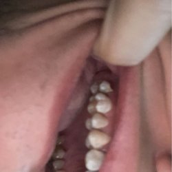 Sonterra Oral & Maxillofacial Surgery Clinic - My back left top molar had to be removed as it was infected .
