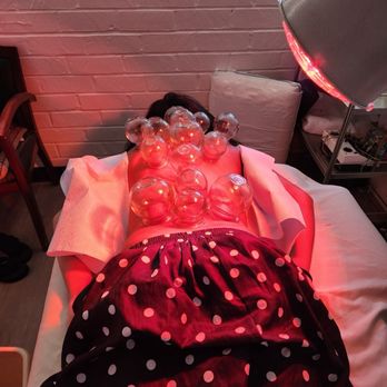 Northridge Acupuncture - Cupping - Acupuncture Near Me - Reseda, California