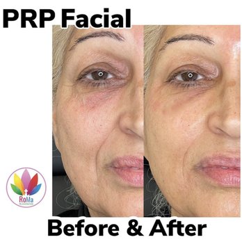 RoMa Rejuvenation - PRP treatments in Riverside California for Skin - Medical Spas Near Me - Riverside, California RoMa Rejuvenation - PRP treatments in Riverside California for Skin - Medical Spas Near Me - Riverside, California