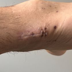 Ross H. Talarico, DPM - Incision