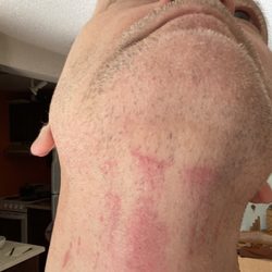 Cook Street Barbershop - Neck badly scratched and burned
