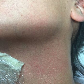 MK Electrolysis - 2 months After (APRIL) -- came back for another clean up! There is a huge difference in my hair! Not as thick-- I have numbing cream on face - Hair Removal Near Me MK Electrolysis - 2 months After (APRIL) -- came back for another clean up! There is a huge difference in my hair! Not as thick-- I have numbing cream on face - Hair Removal Near Me