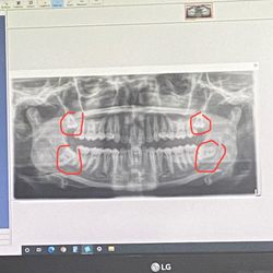 Kenyon M Fort, DDS - Impacted teeth
