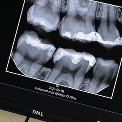 Diablo Hills Dental Excellence - Bottom 2 teeth are were the fillings were done. Unclean work, the floss couldn't even pass through.