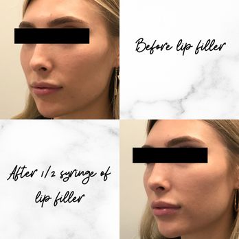 Kind Health Group - Before and after 1/2 syringe of Restylane Kysse by our Nurse Injector, Ari. - Medical Spas Near Me - Encinitas, California Kind Health Group - Before and after 1/2 syringe of Restylane Kysse by our Nurse Injector, Ari. - Medical Spas Near Me - Encinitas, California