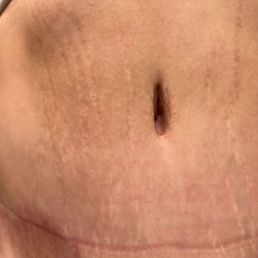 The photos we took before my first treatment