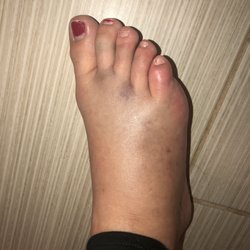 Patient First Primary & Urgent Care - Alexandria - Crushed foot