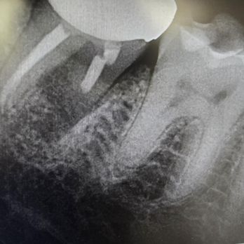 Mahrouz Cohen, DDS - Before where bone was being eaten away at by the infection - Endodontists Near Me - Encino, California Mahrouz Cohen, DDS - Before where bone was being eaten away at by the infection - Endodontists Near Me - Encino, California