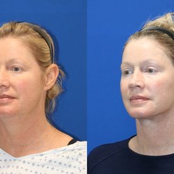 Carmel Valley Facial Plastic Surgery - 16 Months Most Op. Vertical Restore, Custom Fat Transfer, Lower Lid Skin Pinch, Upper Blepharoplasty.