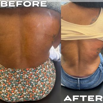 JUST | CRYO - CRYO SHAPING
Area:
Back
Before treatment:
Back lacks definition
After treatment:
Back is defined - Cryotherapy Near Me - Rancho Santa Margarita, California JUST | CRYO - CRYO SHAPING
Area:
Back
Before treatment:
Back lacks definition
After treatment:
Back is defined - Cryotherapy Near Me - Rancho Santa Margarita, California