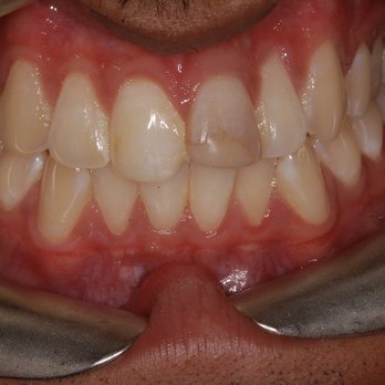Alta Dental Care - BEFORE PHOTO - General Dentistry Near Me - Upland, California