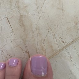 You can see the growers since he filed my toes down so much and severely damaged them. This is 6 weeks post that pedicure. You can see the growers since he filed my toes down so much and severely damaged them. This is 6 weeks post that pedicure.