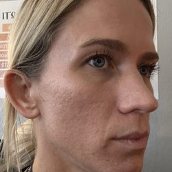 Lux MD - Before