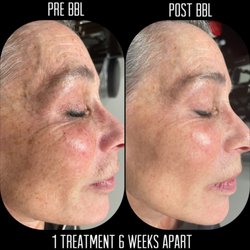 Professional Skin Solutions Medical Spa - BBL - Broad Band Light treatment by Sciton