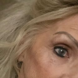 Hodari MD Dermatology & Rejuvené - After the stitches!! healed beautifully!! Can you believe it??