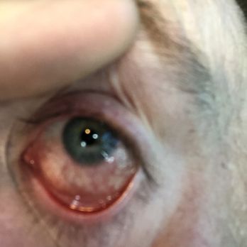 Target Optical - Here is my eye after visiting Dr. Liu. - Optometrists Near Me - Fresno, California Target Optical - Here is my eye after visiting Dr. Liu. - Optometrists Near Me - Fresno, California