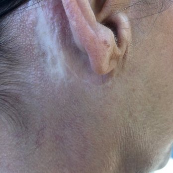 Keller Plastic Surgery - Right ear scarring in back. - Medical Spas Near Me - Santa Barbara, California Keller Plastic Surgery - Right ear scarring in back. - Medical Spas Near Me - Santa Barbara, California