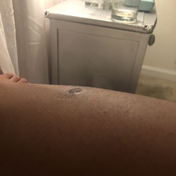 Darst Dermatology - Mole after mole removing appointment - Dermatologists Near Me - Charlotte, North Carolina Darst Dermatology - Mole after mole removing appointment - Dermatologists Near Me - Charlotte, North Carolina