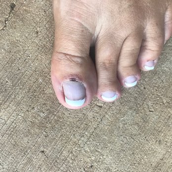 Venice Nail & Spa - Bloody toe cuticle - Nail Salons Near Me - Buda, Texas Venice Nail & Spa - Bloody toe cuticle - Nail Salons Near Me - Buda, Texas