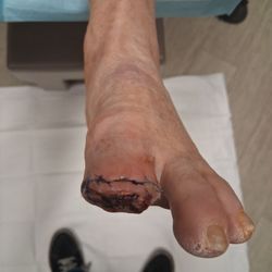 Grant L Beck, DPM - VIP Podiatry - My current amputation of the top of my left big toe