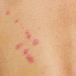 Bed Bug Bites on my back from my stay at Oakhurst Lodge