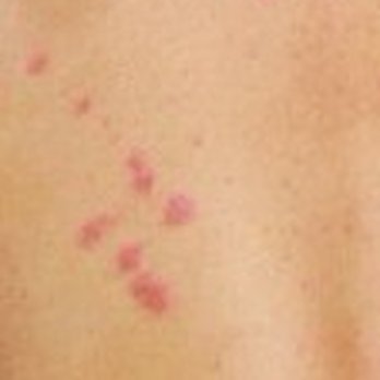 Oakhurst Lodge - Bed Bug Bites on my back from my stay at Oakhurst Lodge - Hotels Near Me - Oakhurst, California