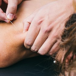 Free Range Acupuncture & Recovery Room - Dry Needling for Trigger Points