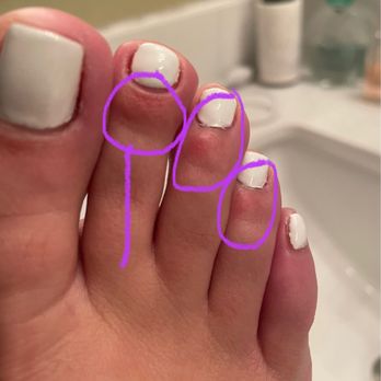 Royal Nails & Spa - Cuts, burns & messed up gel on toes - Nail Salons Near Me - Oceanside, California Royal Nails & Spa - Cuts, burns & messed up gel on toes - Nail Salons Near Me - Oceanside, California
