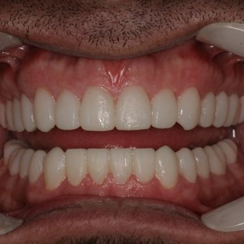 Richard Hamaty, DMD - Full Mouth Rehabilitation with Temporaries - General Dentistry Near Me - Yorba Linda, California Richard Hamaty, DMD - Full Mouth Rehabilitation with Temporaries - General Dentistry Near Me - Yorba Linda, California