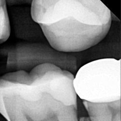 ZenDental - Alessandra Raschkovsky, DDS - Crown not seated properly