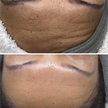 Facials By Alicia - Microdermabrasion   ‍ - Skin Care Near Me - Lancaster, California
