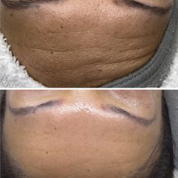 Facials By Alicia - Microdermabrasion   ‍