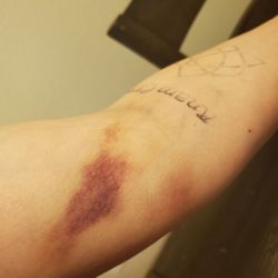 CSL Plasma - Initial injection site, a full week healed.
