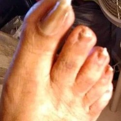Womick Podiatry Clinic - This is how Podiatrists Lee Womick left my toes after clipping my toe nails.