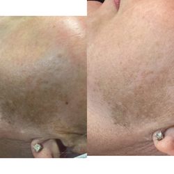 D's Brow Bar and Skincare - Chemical peel before & after