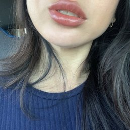 Lip and chin filler by the best in SD