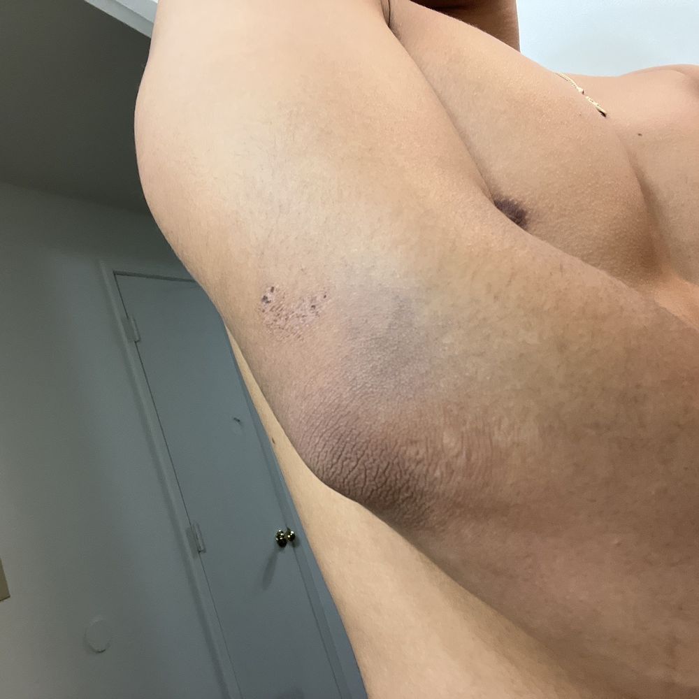 Providence Bridgeport Immediate Care - More bruising - Urgent Care Near Me - Tigard, Oregon Providence Bridgeport Immediate Care - More bruising - Urgent Care Near Me - Tigard, Oregon