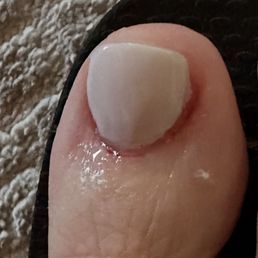 Burned and cut my toe. Very painful. Put Neosporin on it. 3 hrs later...dried blood all around the nail. Burned and cut my toe. Very painful. Put Neosporin on it. 3 hrs later...dried blood all around the nail.