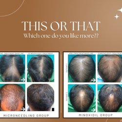 AcuGlo - A comparison of different patients trying different treatment methods. You can clearly see the success is far better with microneedling.