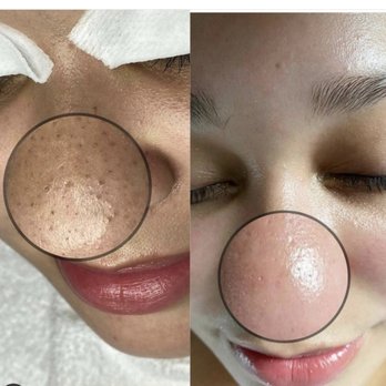 Honest Beauty - Extractions - Skin Care Near Me - West Hartford, Connecticut