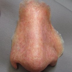 Medical Art Prosthetics - Nose prosthesis