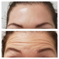 Clinica Medica - Before and after Botox