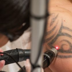Removery Tattoo Removal & Fading