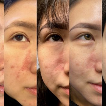 Scar Healing Institute - Progress from left to right: Nov, Dec, Jan, Feb, April 2021 (lol at my brow transformation as well) - Dermatologists Near Me - Beverly Hills, California Scar Healing Institute - Progress from left to right: Nov, Dec, Jan, Feb, April 2021 (lol at my brow transformation as well) - Dermatologists Near Me - Beverly Hills, California