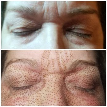 Xo Skin & Lash - Eye lid lift, face lift and forehead (11's) treatment. As shown the eyelids were already tighter after the session! - Skin Care Near Me Xo Skin & Lash - Eye lid lift, face lift and forehead (11's) treatment. As shown the eyelids were already tighter after the session! - Skin Care Near Me