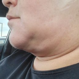 Abril 2,2024 lipo y j plasma  Estoy en proceso de recuperación más adelante nuevas fotos