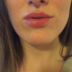 Okanagan Skin Care Centre - Voila after. I think this could be an addiction.. Almost 3 hrs out and I want more... Haha uh oh.