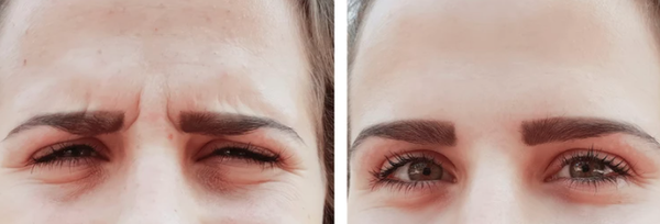Before & After - The Best Botox Injector in Renton, WA.