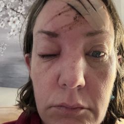 Berkshire Medical Center - How I looked after getting home. Clearly no wound care.